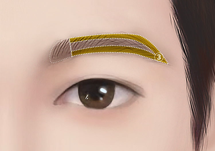 눈썹이식으로 눈썹 주변부에 가는 모를 이식한 남자의 그림 