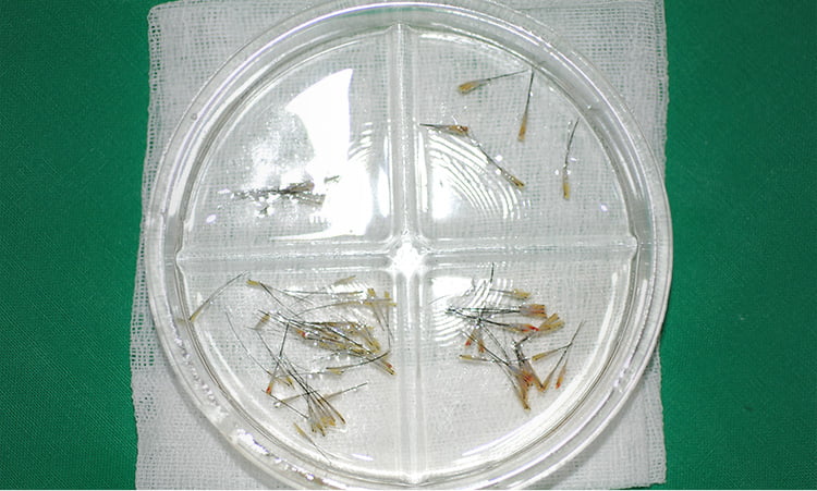 재생인자에 담구어진 모낭들