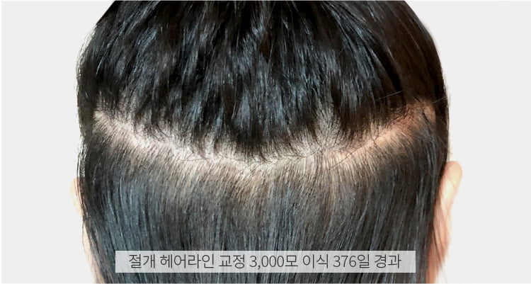 절개 헤어라인 교정 후 1년 경과 사진