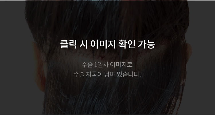 절개 헤어라인 교정 직후 뒤통수 사진