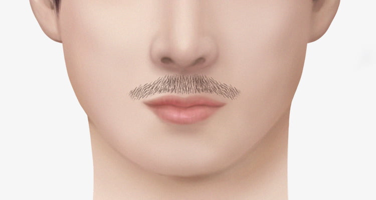 콧수염을 모발이식한 남자의 사진