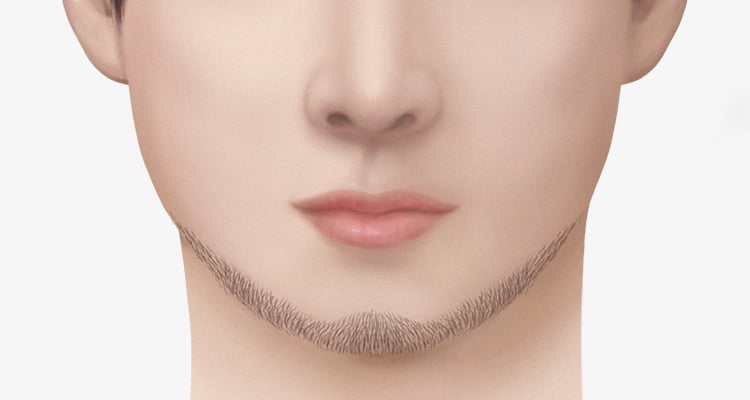 턱수염을 이식한 남자의 사진