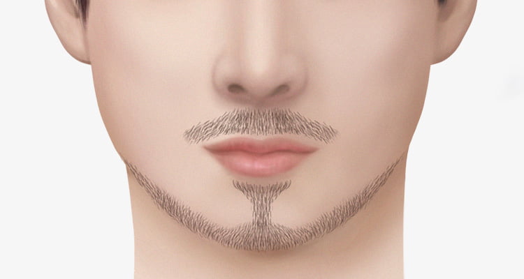 콧수염과 턱수염을 이식한 남자의 사진