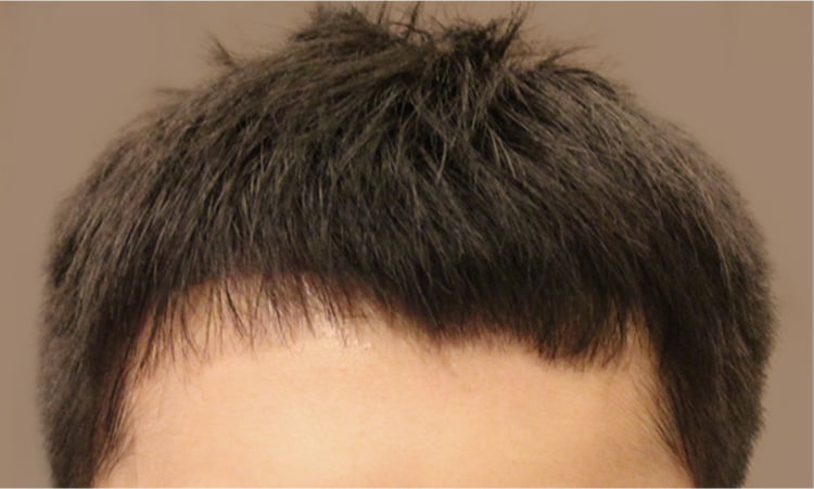 비절개 수술 다음날 남자의 정면 사진