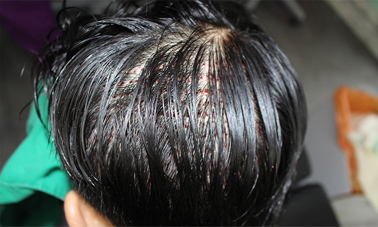 하이드 컷 수술 직후 기존 머리로 채취 부위를 가린 티가 나지 않는 남자의 후두부 사진