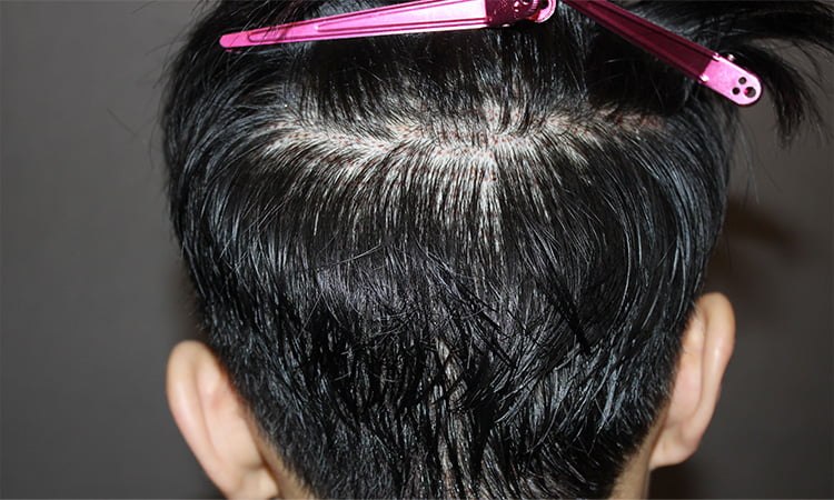 하이드 컷 수술 다음 날 기존 머리로 채취 부위를 가려 티가 나지 않는 남자의 후두부 사진