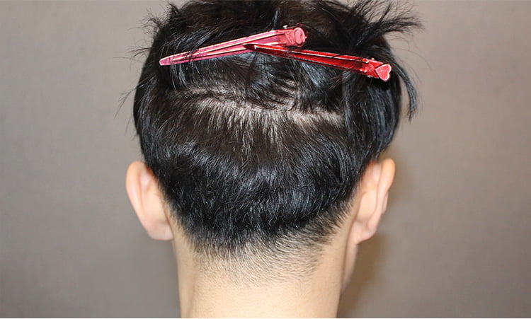 하이드 컷 수술 22일 후 흉터가 남지 않은 남자의 후두부 사진