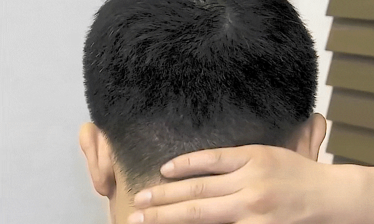 모제림 비절개 수술 후 1년이 지나 흉터가 티가 나지 않는 남자의 후두부 사진