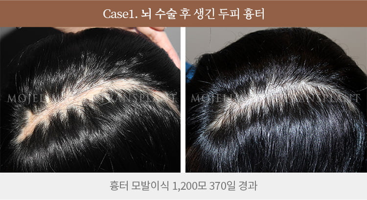 흉터 이식 전후 사진