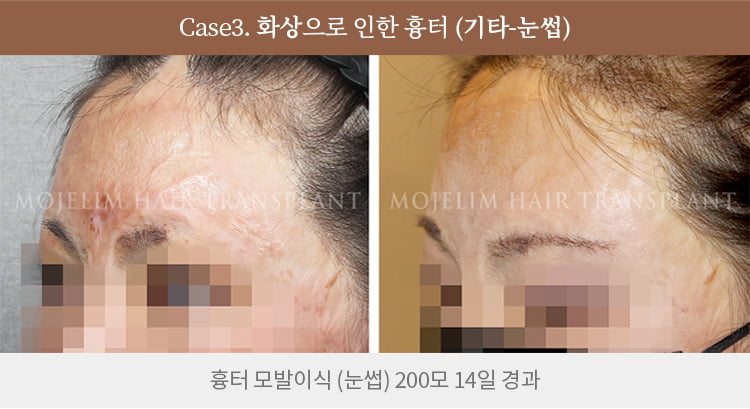 흉터 이식 전후 사진