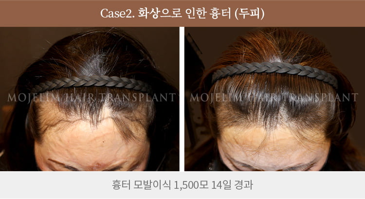 흉터 이식 전후 사진