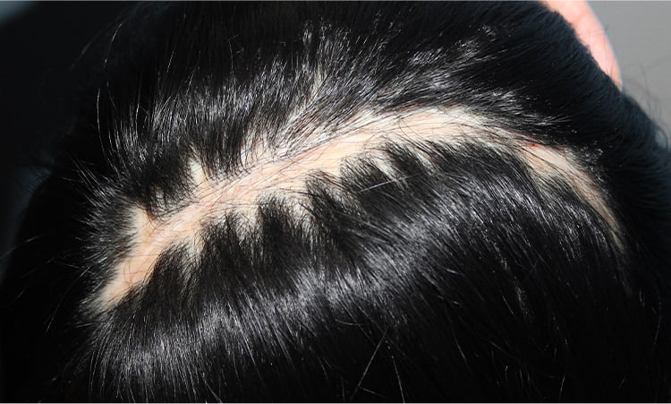 의료 수술 후 정수리에 머리 털이 안나는 정수리 흉터