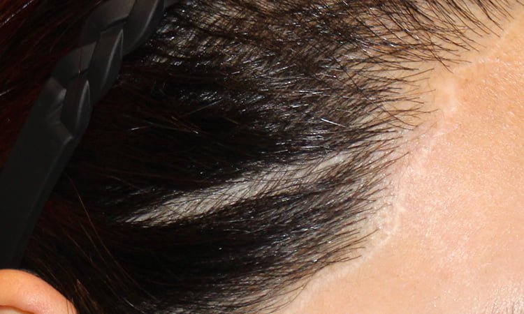 미용 성형 수술 후 흉터가 생긴 헤어라인