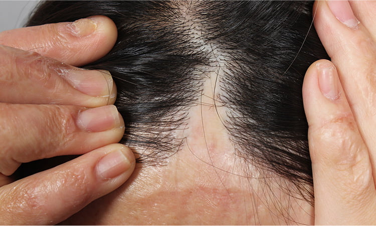 사고로 인해 모발이 안나는 이마 흉터