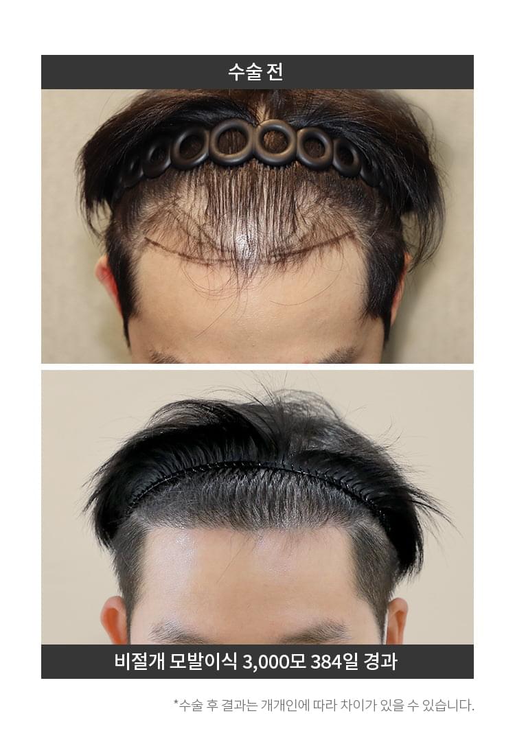 비절개 모발이식 3,000모 이후 384일이 지난 남자의 머리