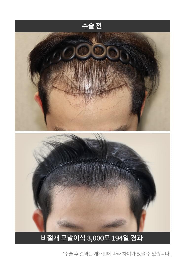 비절개 모발이식 3,000모 이후 194일이 지난 남자의 머리