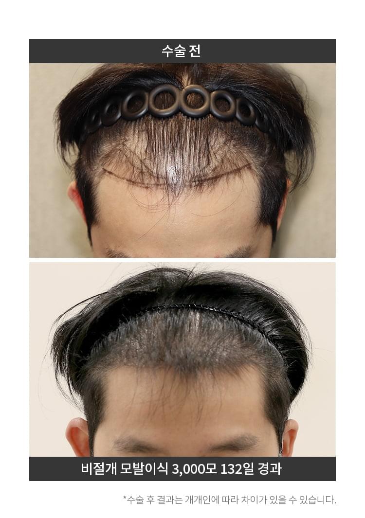 비절개 모발이식 3,000모 이후 132일이 지난 남자의 머리