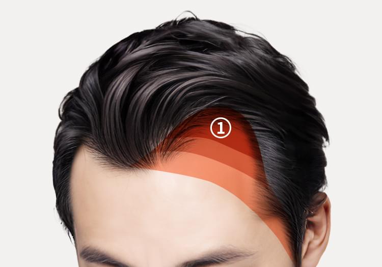 자연스러운 모발의 배치를 위해 구조적으로 모낭을 배치한 남자의 머리 사진