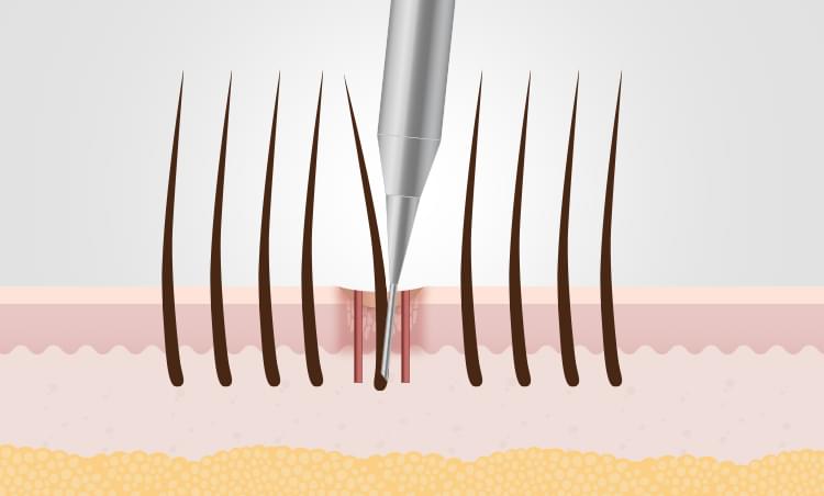 흉터 이식 수술 방법