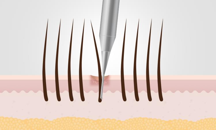 흉터 이식 수술 방법