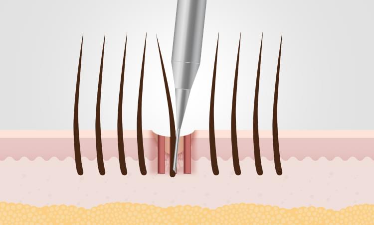 흉터 이식 수술 방법