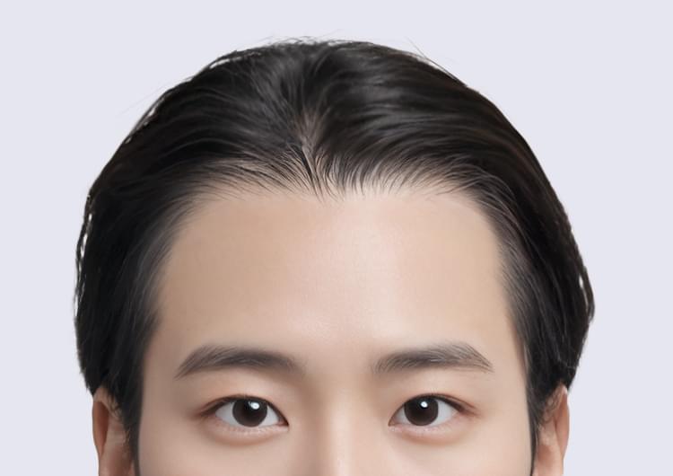 비절개 모발이식으로 4천5백 모를 이식하고 453일이 지난 남자의 머리 사진