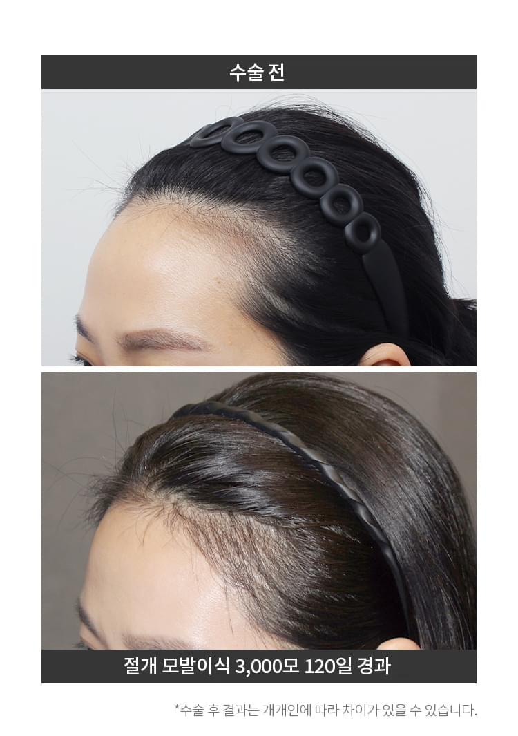 3000모 헤어라인 교정 후 120일 경과한 여성의 이마
