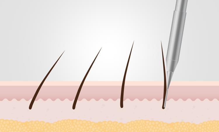 전체적으로 완성도를 높이기 위해 이식하는 모발의 방향과 각도를 조정하는 식모기의 그림