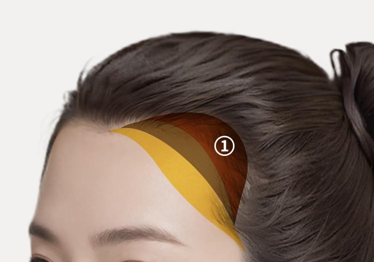 헤어라인 이식 영역 내에 구조적 모낭을 배치에 자연스러운 헤어라인 완성