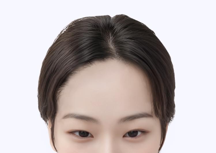 절개 헤어라인 교정 3,000모 이식 후 466일 경과한 여성의 이마 사진