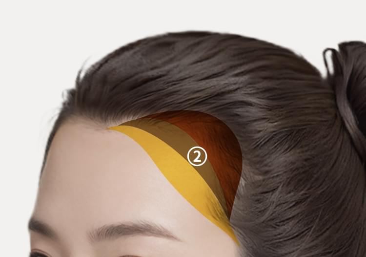 헤어라인 이식 영역 내에 구조적 모낭을 배치에 자연스러운 헤어라인 완성