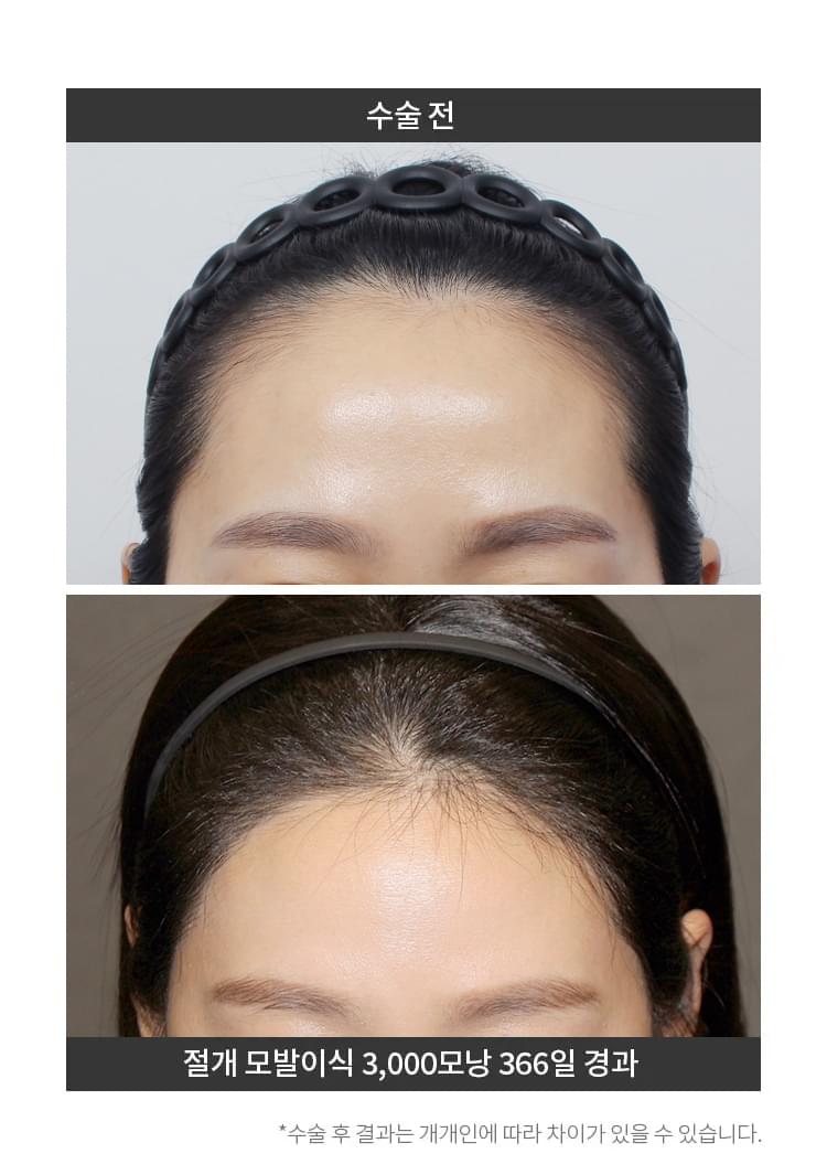 3000모 헤어라인 교정 후 1년 경과한 여성의 이마
