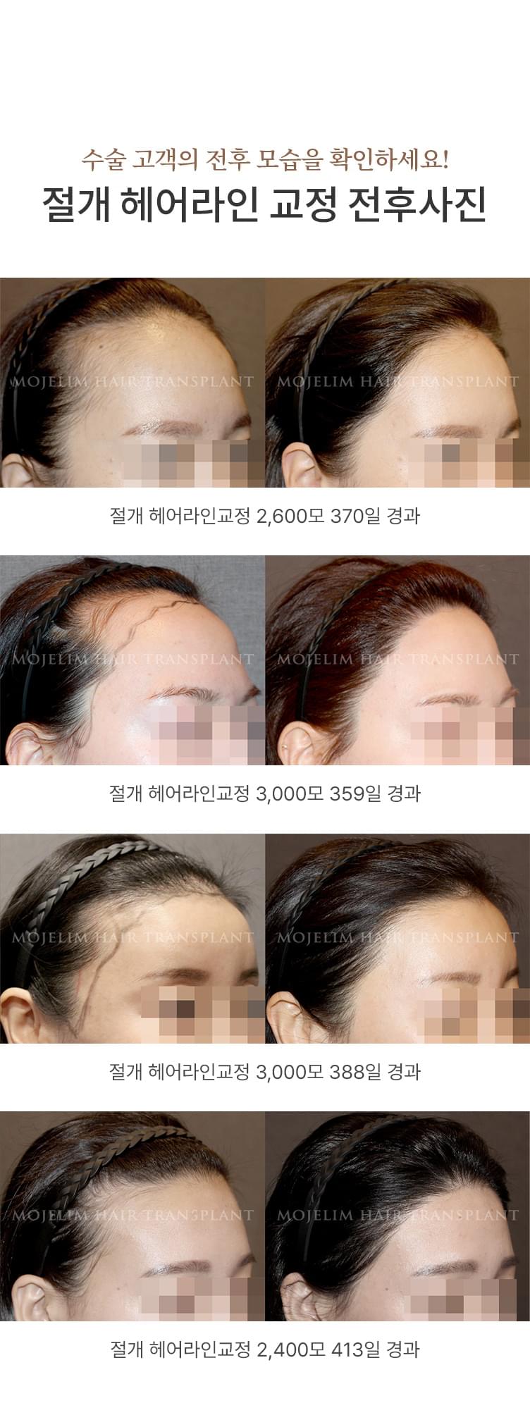 비절개 헤어라인 교정 전후